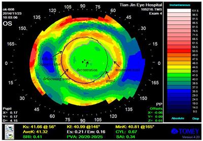 Evaluation of the corneal topography based on deep learning